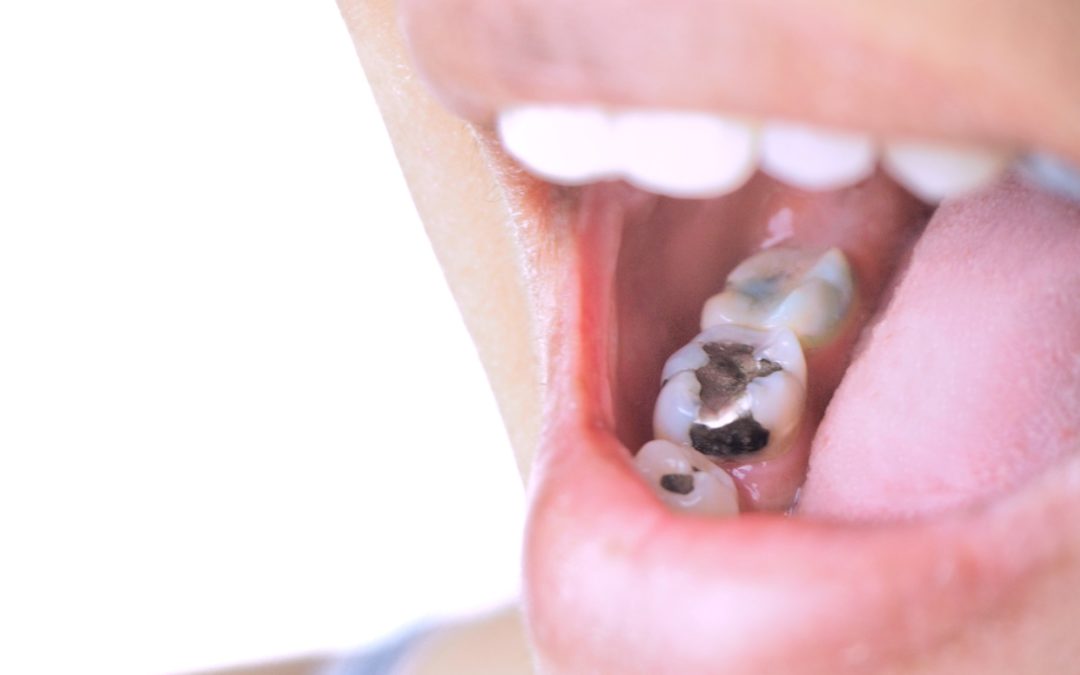 What Causes Cavities? Plus, What You Can Do to Prevent Them?